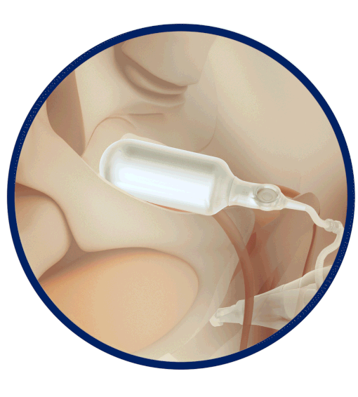 AdaptiveReservoir<sup>™</sup> AdaptiveReservoir<sup>™</sup>