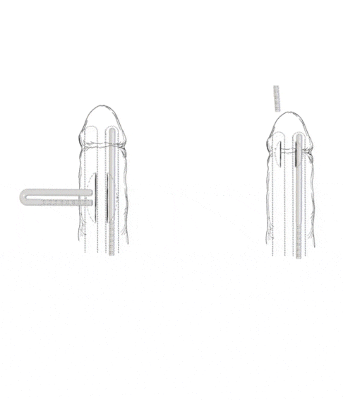 سهل الزرع Easy to Implant