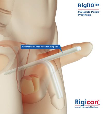 Rigi10&trade; Malleable Penile Prosthesis Product Illustration